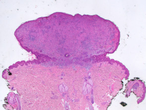 BAP-oma histology low power view of pedunculated lesion