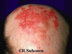 Effects of fluorouracil cream applied to actinic keratoses