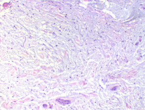 Focal mucinosis figure4