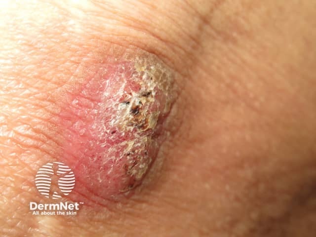 Silica granuloma