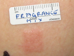 Positive patch test to fragrance