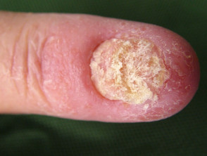 Candidal nail infection