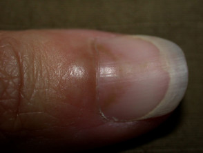 Candida albicans affecting the nails