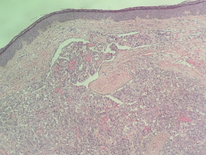 Glomeruloid hemangioma pathology
