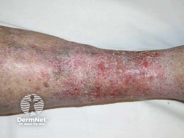 Venous eczema