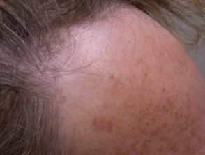 Fibrosing alopecia