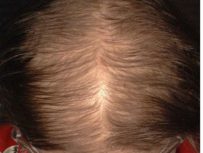 Female pattern hair loss