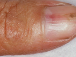 Glomus tumour of nail