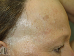 Graham Little syndrome. Scarring alopecia of anterior scalp