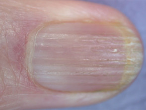Longitudinal nail ridging