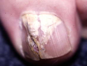 Longitudinal splitting of nail
