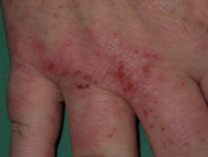 hand dermatitis in patient on antiTNF