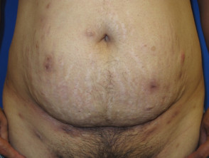 Hidradenitis suppurativa of abdomen