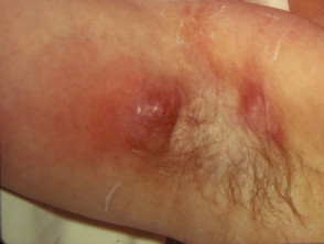 Hidradenitis suppurativa of axilla