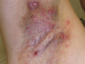 Hidradenitis suppurativa of axilla