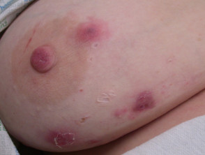 Hidradenitis suppurativa of breast