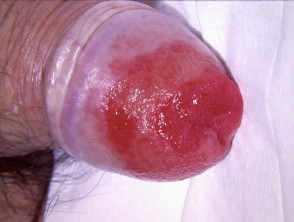Penile high grade squamous epithelial lesion