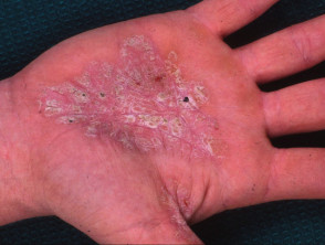 Hyperkeratotic hand eczema