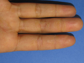 Hyperkeratotic hand eczema