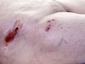 Cicatricial pemphigoid