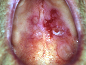 Cicatricial pemphigoid