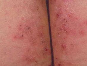 Scabies On Knee Dermatitis herpetiformis DermNet NZ