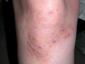 Scabies On Knee Dermatitis herpetiformis DermNet NZ