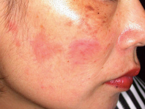 Cutaneous lupus erythematosus 