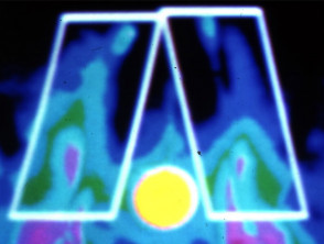 Raynaud phenomenon on thermal imaging