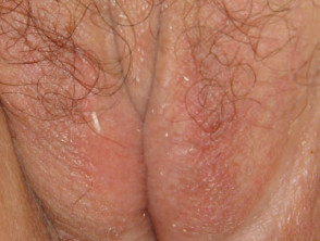 Vulval lichen sclerosus 