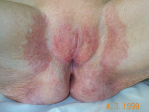 Vulval lichen sclerosus 