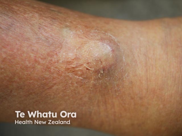 Cutaneous plasmacytoma