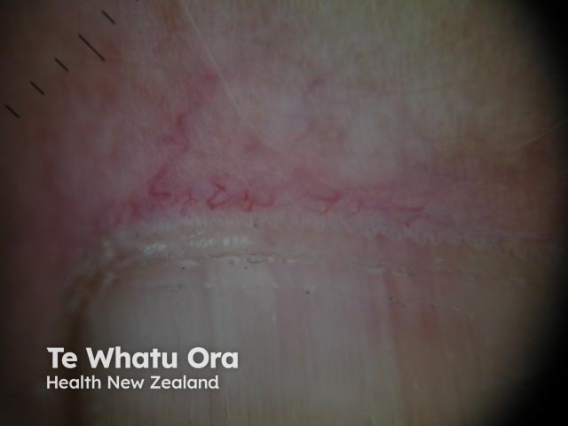 Nail-fold capillaries