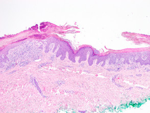 keratosis lichenoides chronica figure 4