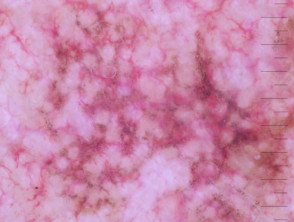 Annular granular pattern seen in lentigo maligna demoscopy