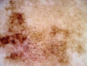 Asymmetrical pigmented follicular openings in lentigo maligna dermoscopy