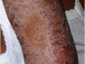 Borderline tuberculoid leprosy with type 1 reaction