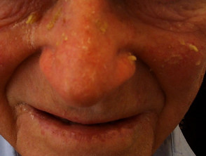 Actinic Keratoses affecting the face