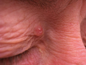 Basal cell carcinoma affecting the eyelid 
