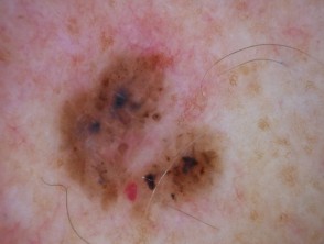 Basal cell carcinoma affecting the face images | DermNet NZ
