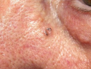 Basal cell carcinoma affecting the face images | DermNet NZ