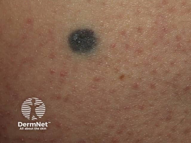 A blue naevus - the monochrome slate blue colour is typical