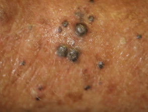 Metastatic melanoma