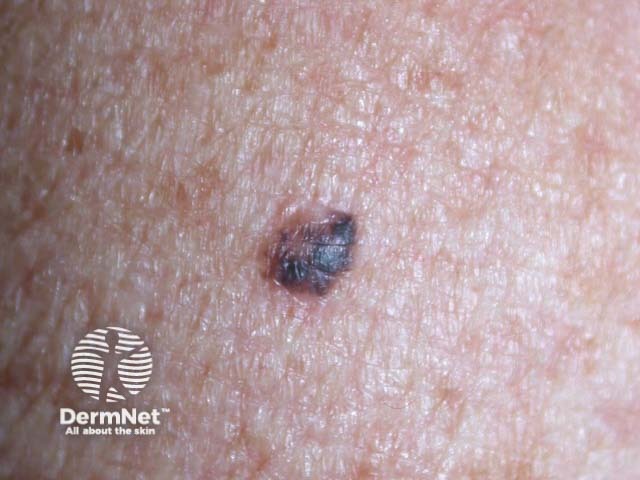 Intraepidermal carcinoma