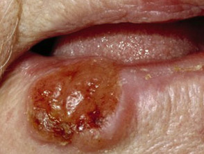 Squamous cell carcinoma of the lip images | DermNet NZ