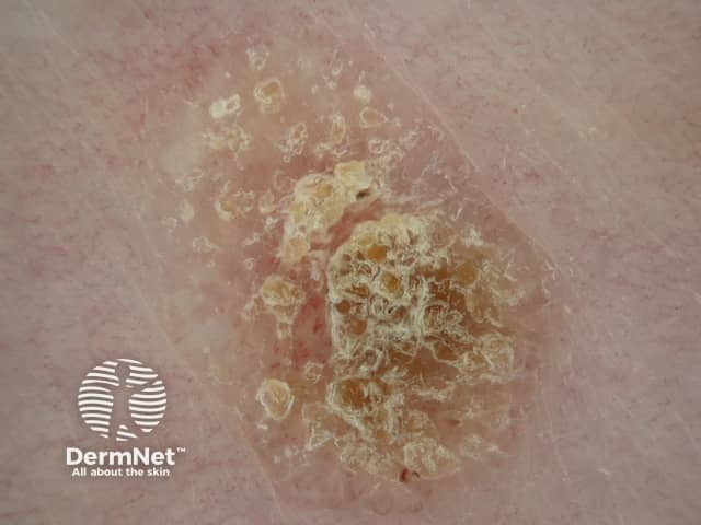 Seborrhoeic keratosis dermoscopy