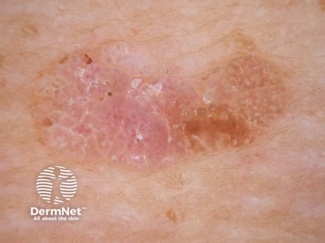 Seborrhoeic keratosis dermoscopy