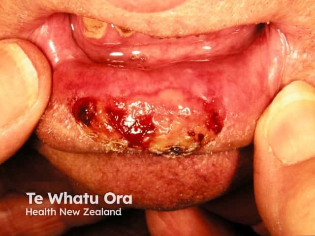 High-risk cutaneous squamous cell carcinoma