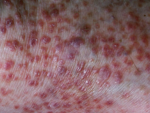 Lichen amyloidosis