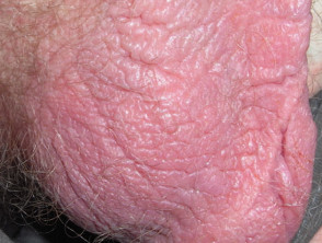 Lichen simplex of the scrotum